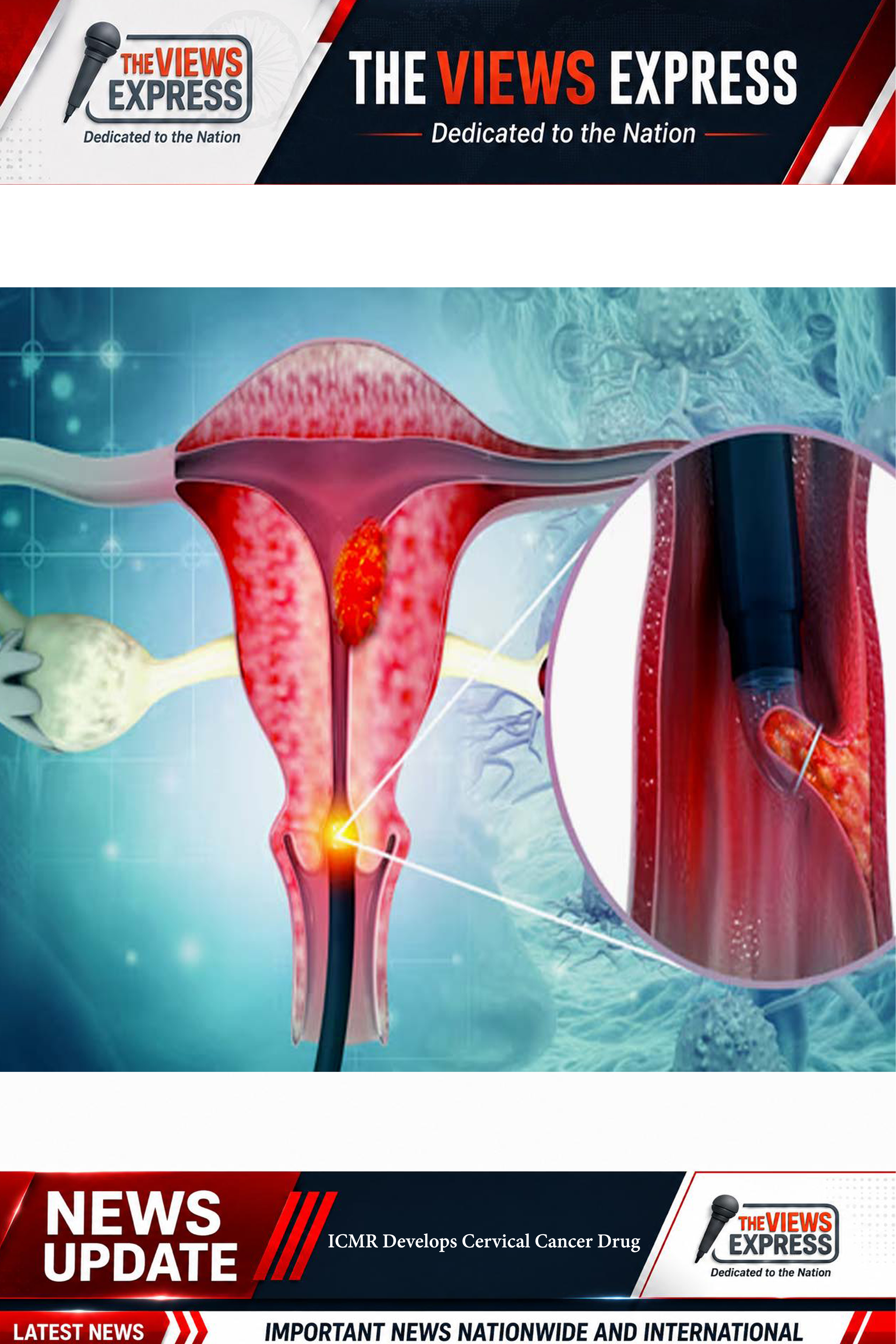 ICMR Develops Promising Drug Against Cervical Cancer, Clinical Trials Underway In India
