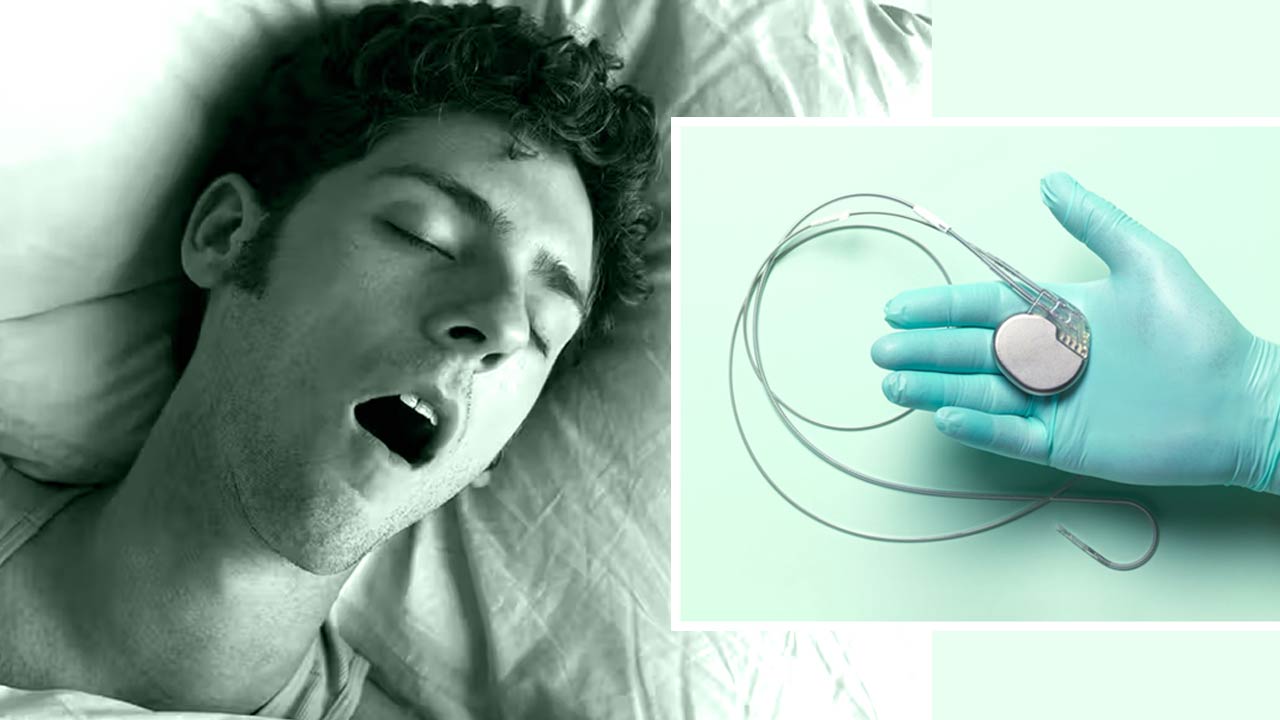Tongue Pacemaker Offers Hope For Snoring And Sleep Apnea Patients Worldwide